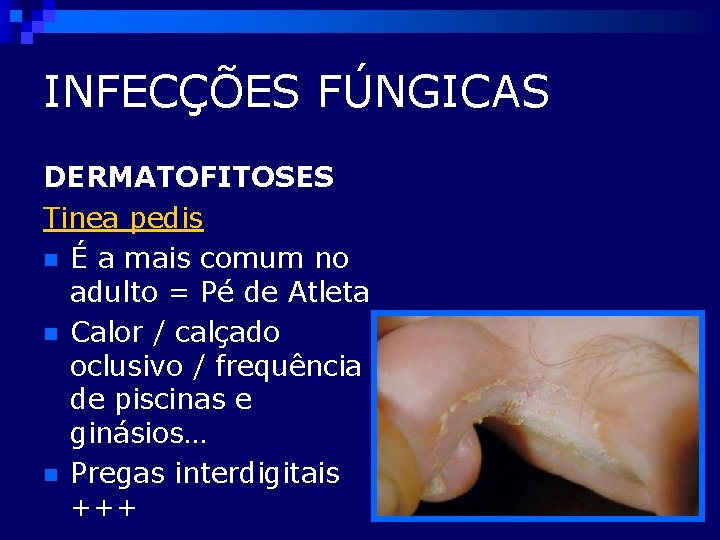 INFECÇÕES FÚNGICAS DERMATOFITOSES Tinea pedis n É a mais comum no adulto = Pé