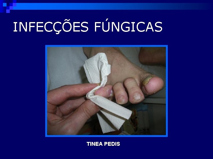 INFECÇÕES FÚNGICAS TINEA PEDIS 