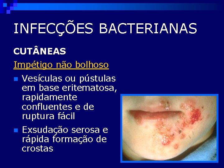 INFECÇÕES BACTERIANAS CUT NEAS Impétigo não bolhoso n Vesículas ou pústulas em base eritematosa,