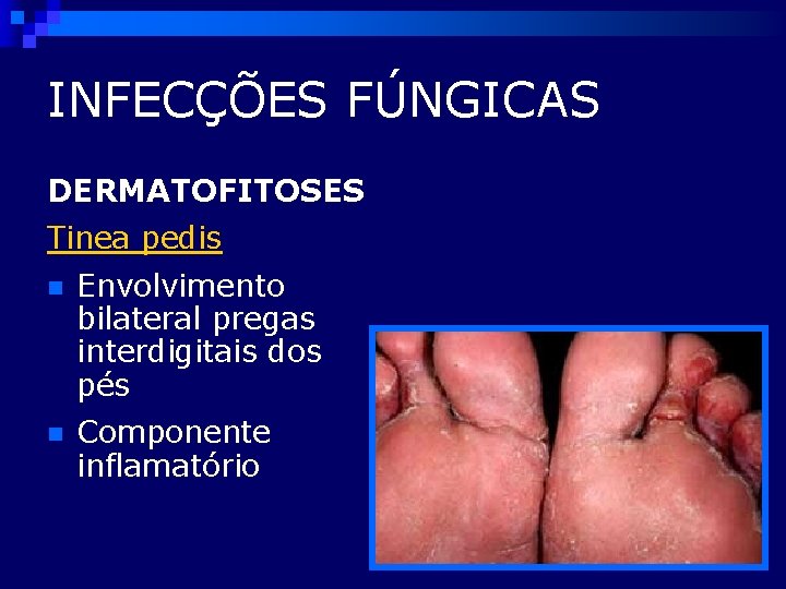 INFECÇÕES FÚNGICAS DERMATOFITOSES Tinea pedis n Envolvimento bilateral pregas interdigitais dos pés n Componente