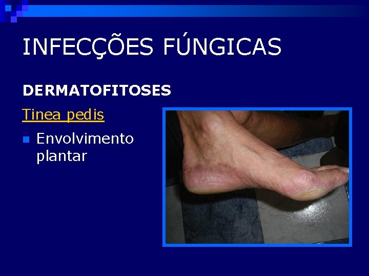 INFECÇÕES FÚNGICAS DERMATOFITOSES Tinea pedis n Envolvimento plantar 