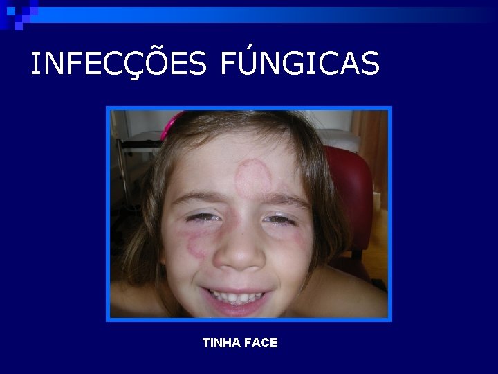 INFECÇÕES FÚNGICAS TINHA FACE 