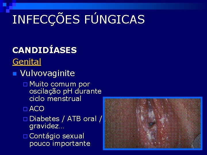INFECÇÕES FÚNGICAS CANDIDÍASES Genital n Vulvovaginite ¨ Muito comum por oscilação p. H durante