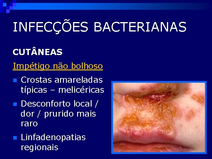 INFECÇÕES BACTERIANAS CUT NEAS Impétigo não bolhoso n Crostas amareladas típicas – melicéricas n