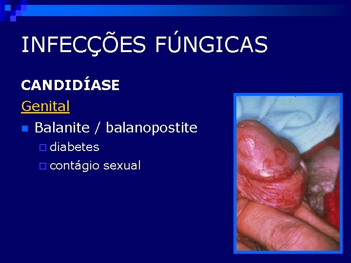 INFECÇÕES FÚNGICAS CANDIDÍASE Genital n Balanite / balanopostite ¨ diabetes ¨ contágio sexual 