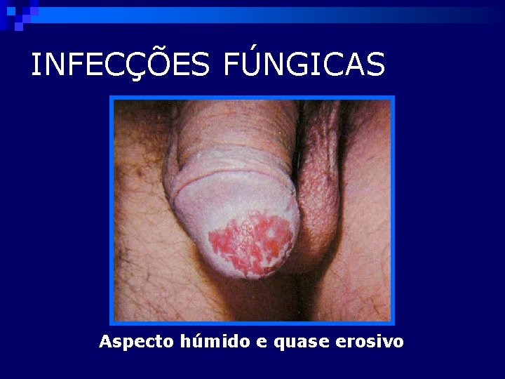 INFECÇÕES FÚNGICAS Aspecto húmido e quase erosivo 