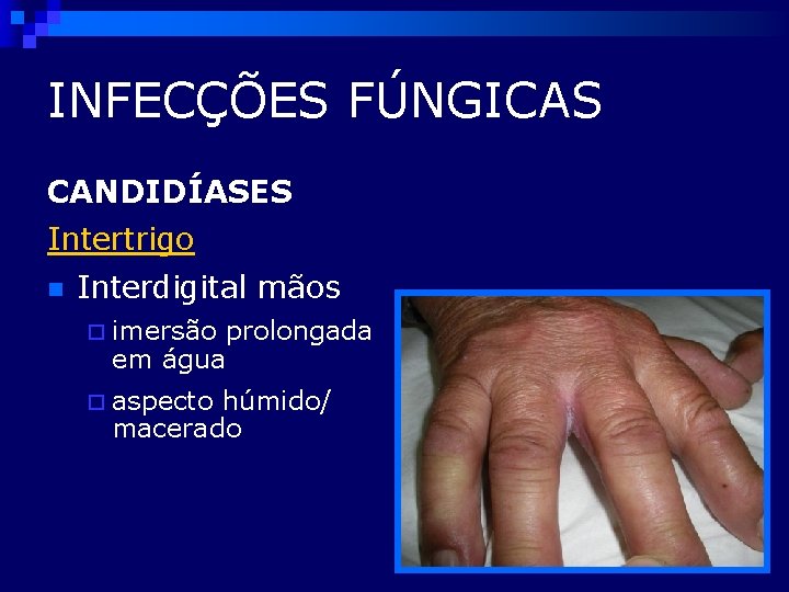 INFECÇÕES FÚNGICAS CANDIDÍASES Intertrigo n Interdigital mãos ¨ imersão prolongada em água ¨ aspecto