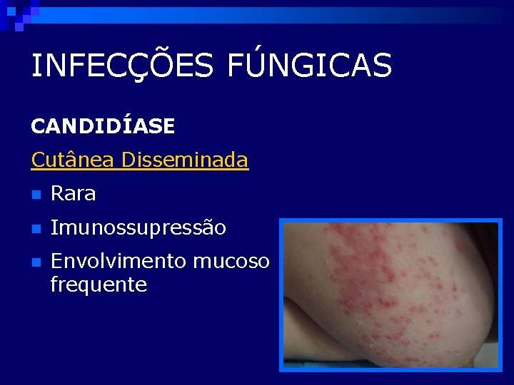 INFECÇÕES FÚNGICAS CANDIDÍASE Cutânea Disseminada n Rara n Imunossupressão n Envolvimento mucoso frequente 