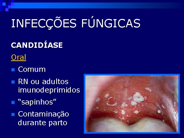 INFECÇÕES FÚNGICAS CANDIDÍASE Oral n Comum n RN ou adultos imunodeprimidos n “sapinhos” n