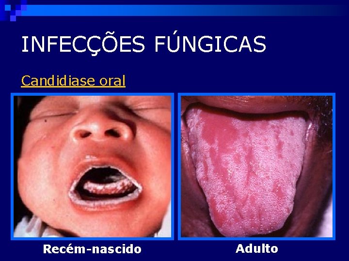 INFECÇÕES FÚNGICAS Candidiase oral Recém-nascido Adulto 