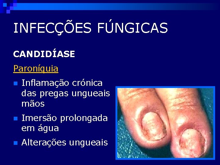 INFECÇÕES FÚNGICAS CANDIDÍASE Paroníquia n Inflamação crónica das pregas ungueais mãos n Imersão prolongada