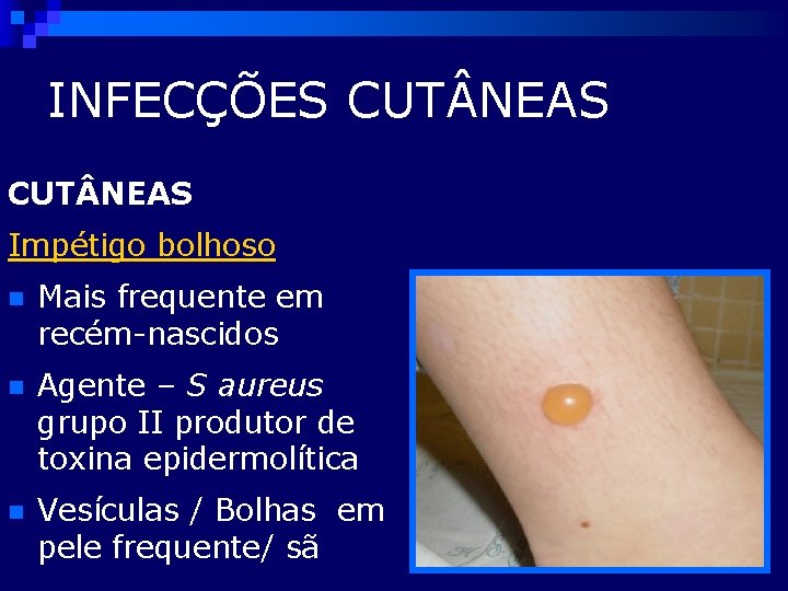 INFECÇÕES CUT NEAS Impétigo bolhoso n Mais frequente em recém-nascidos n Agente – S
