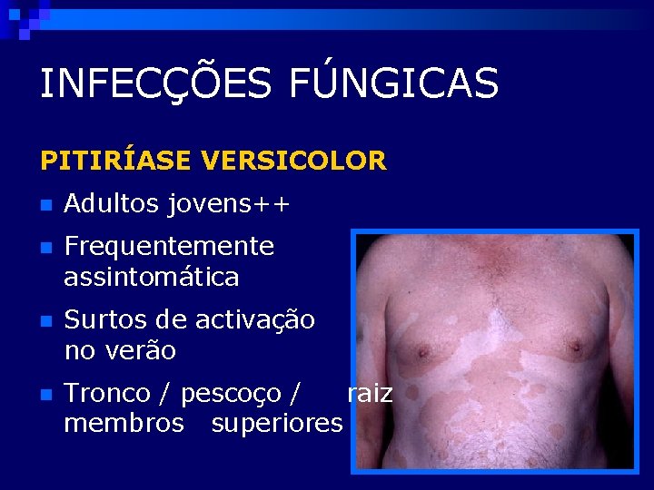 INFECÇÕES FÚNGICAS PITIRÍASE VERSICOLOR n Adultos jovens++ n Frequentemente assintomática n Surtos de activação