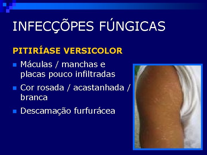 INFECÇÕPES FÚNGICAS PITIRÍASE VERSICOLOR n Máculas / manchas e placas pouco infiltradas n Cor