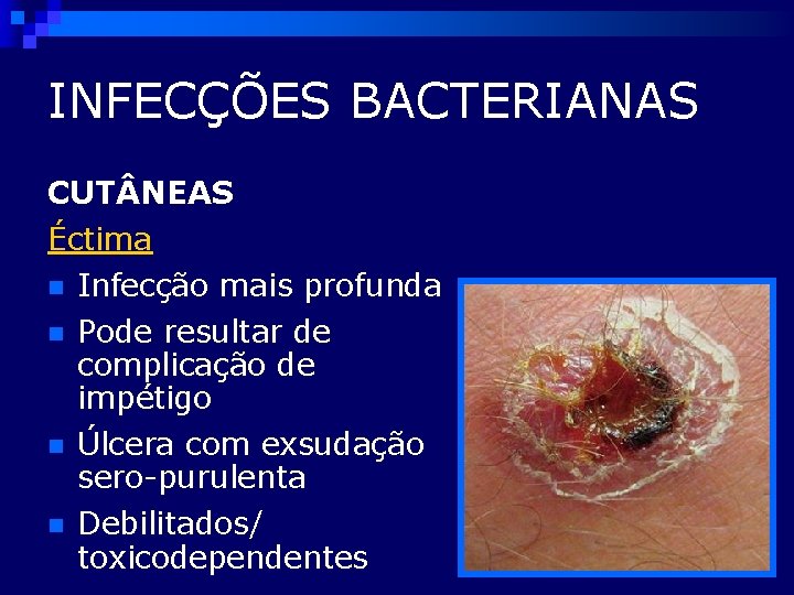INFECÇÕES BACTERIANAS CUT NEAS Éctima n Infecção mais profunda n Pode resultar de complicação