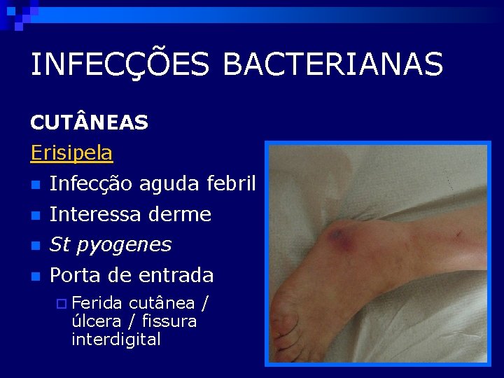INFECÇÕES BACTERIANAS CUT NEAS Erisipela n Infecção aguda febril n Interessa derme n St