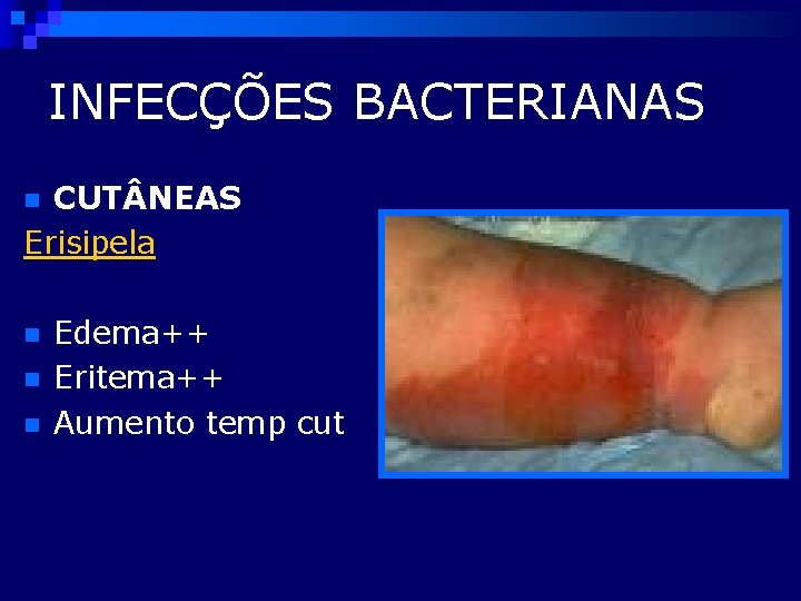 INFECÇÕES BACTERIANAS CUT NEAS Erisipela n n Edema++ Eritema++ Aumento temp cut 