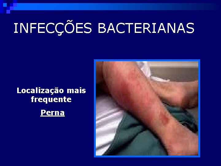 INFECÇÕES BACTERIANAS Localização mais frequente Perna 