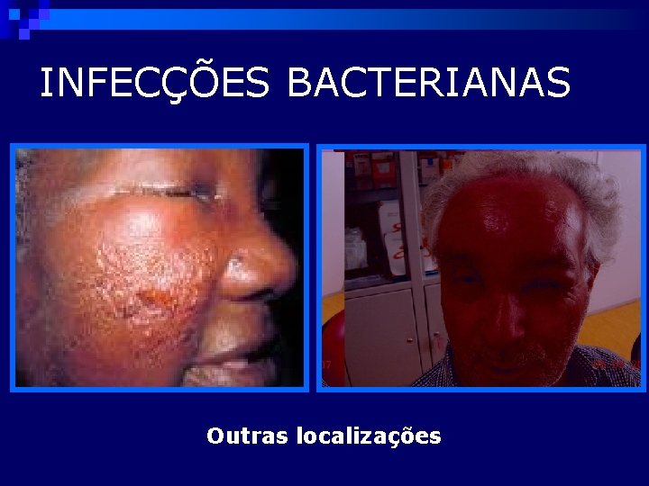 INFECÇÕES BACTERIANAS Outras localizações 