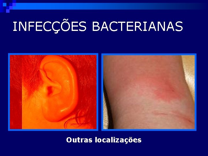 INFECÇÕES BACTERIANAS Outras localizações 