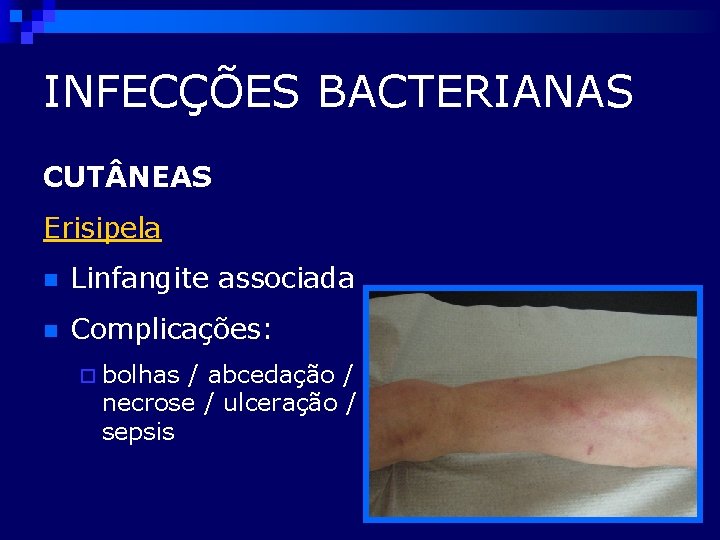 INFECÇÕES BACTERIANAS CUT NEAS Erisipela n Linfangite associada n Complicações: ¨ bolhas / abcedação