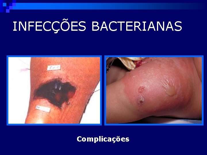 INFECÇÕES BACTERIANAS Complicações 