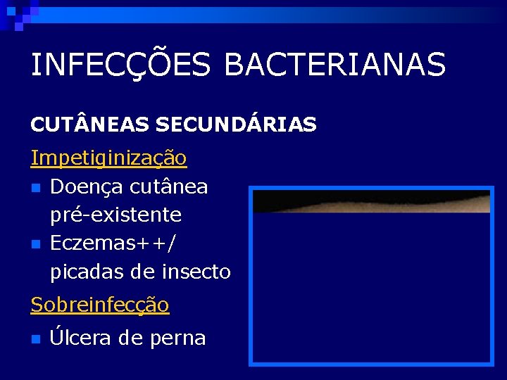 INFECÇÕES BACTERIANAS CUT NEAS SECUNDÁRIAS Impetiginização n Doença cutânea pré-existente n Eczemas++/ picadas de