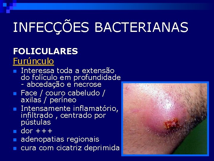 INFECÇÕES BACTERIANAS FOLICULARES Furúnculo n n n Interessa toda a extensão do folículo em