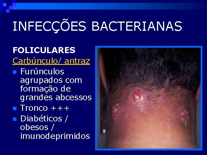 INFECÇÕES BACTERIANAS FOLICULARES Carbúnculo/ antraz n Furúnculos agrupados com formação de grandes abcessos n