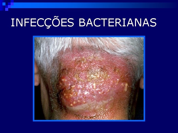 INFECÇÕES BACTERIANAS 