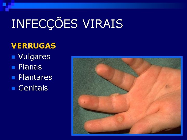 INFECÇÕES VIRAIS VERRUGAS n Vulgares n Planas n Plantares n Genitais 