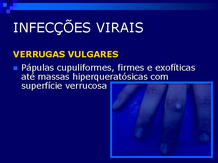 INFECÇÕES VIRAIS VERRUGAS VULGARES n Pápulas cupuliformes, firmes e exofíticas até massas hiperqueratósicas com