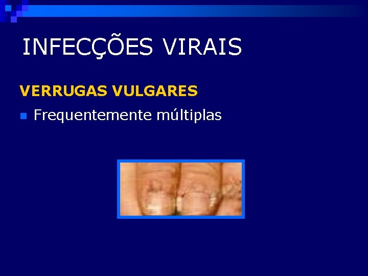 INFECÇÕES VIRAIS VERRUGAS VULGARES n Frequentemente múltiplas 