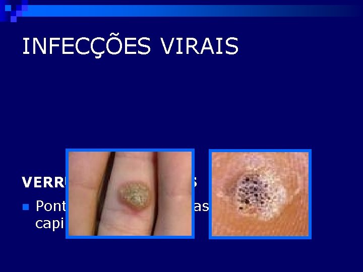 INFECÇÕES VIRAIS VERRUGAS VULGARES n Ponteado vermelho acastanhado por capilares trombosados 