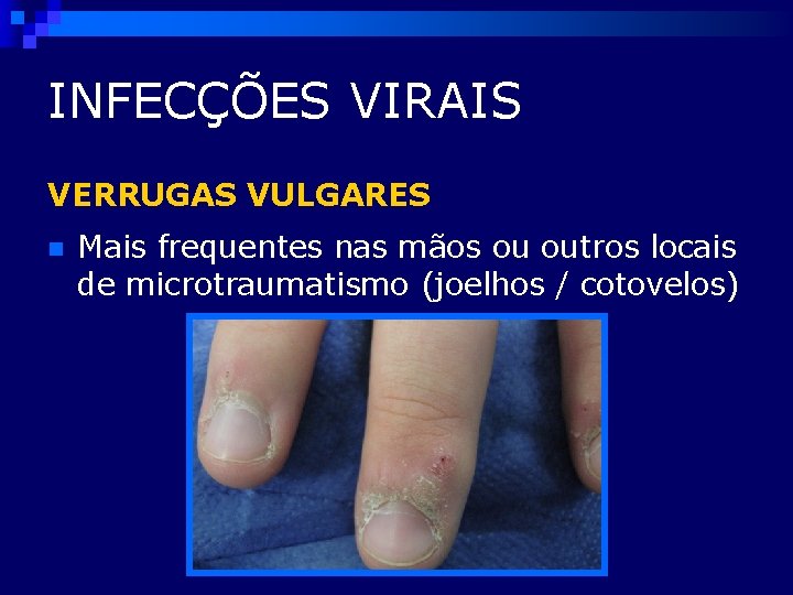 INFECÇÕES VIRAIS VERRUGAS VULGARES n Mais frequentes nas mãos ou outros locais de microtraumatismo