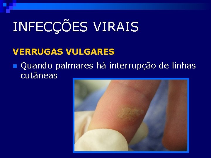 INFECÇÕES VIRAIS VERRUGAS VULGARES n Quando palmares há interrupção de linhas cutâneas 