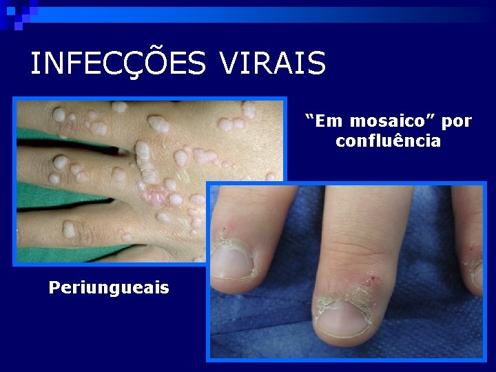 INFECÇÕES VIRAIS “Em mosaico” por confluência Periungueais 
