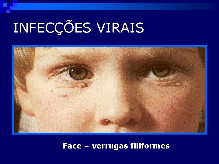 INFECÇÕES VIRAIS Face – verrugas filiformes 