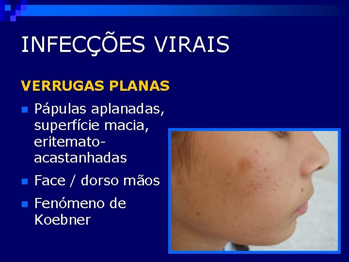 INFECÇÕES VIRAIS VERRUGAS PLANAS n Pápulas aplanadas, superfície macia, eritematoacastanhadas n Face / dorso