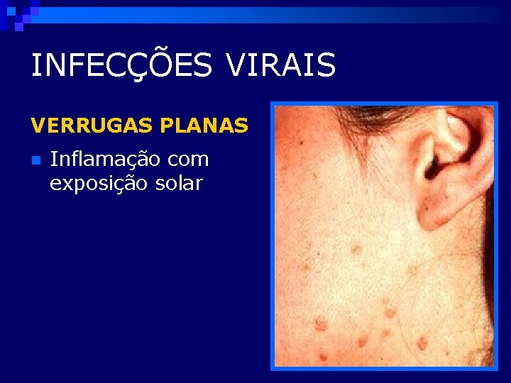 INFECÇÕES VIRAIS VERRUGAS PLANAS n Inflamação com exposição solar 