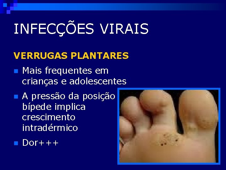 INFECÇÕES VIRAIS VERRUGAS PLANTARES n Mais frequentes em crianças e adolescentes n A pressão