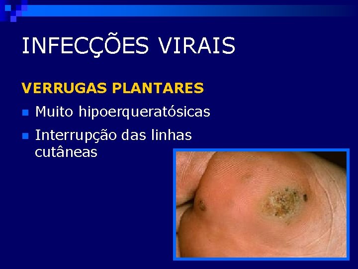 INFECÇÕES VIRAIS VERRUGAS PLANTARES n Muito hipoerqueratósicas n Interrupção das linhas cutâneas 