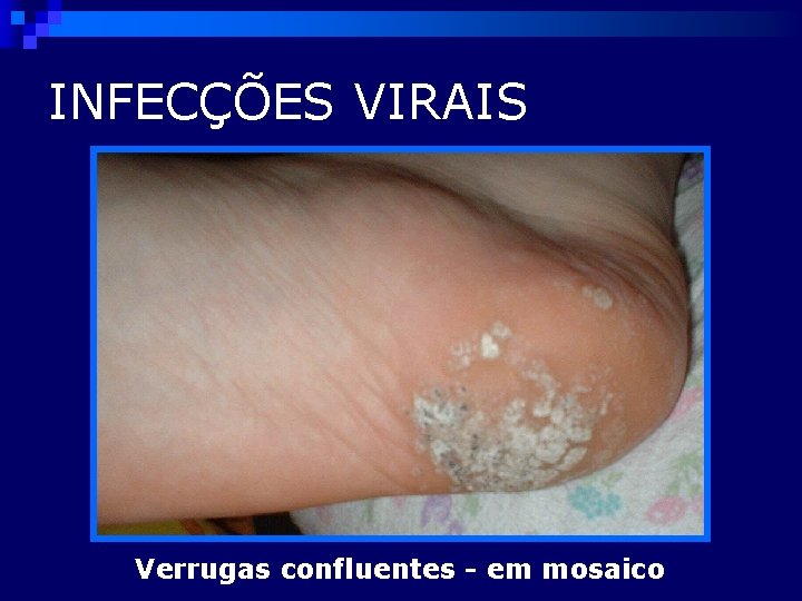 INFECÇÕES VIRAIS Verrugas confluentes - em mosaico 