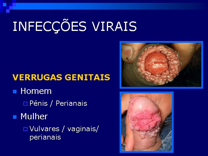 INFECÇÕES VIRAIS VERRUGAS GENITAIS n Homem ¨ Pénis n / Perianais Mulher ¨ Vulvares
