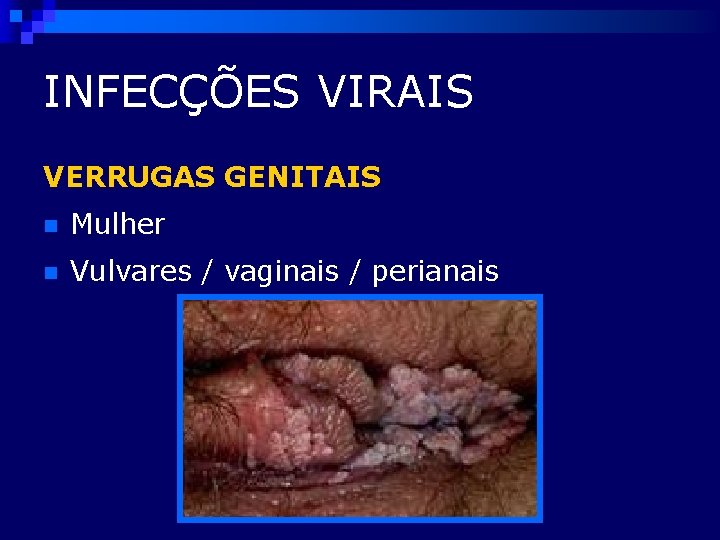 INFECÇÕES VIRAIS VERRUGAS GENITAIS n Mulher n Vulvares / vaginais / perianais 