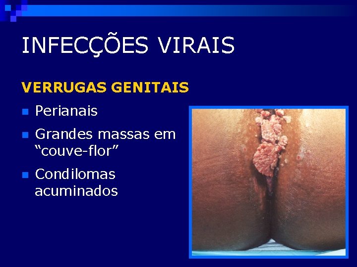 INFECÇÕES VIRAIS VERRUGAS GENITAIS n Perianais n Grandes massas em “couve-flor” n Condilomas acuminados