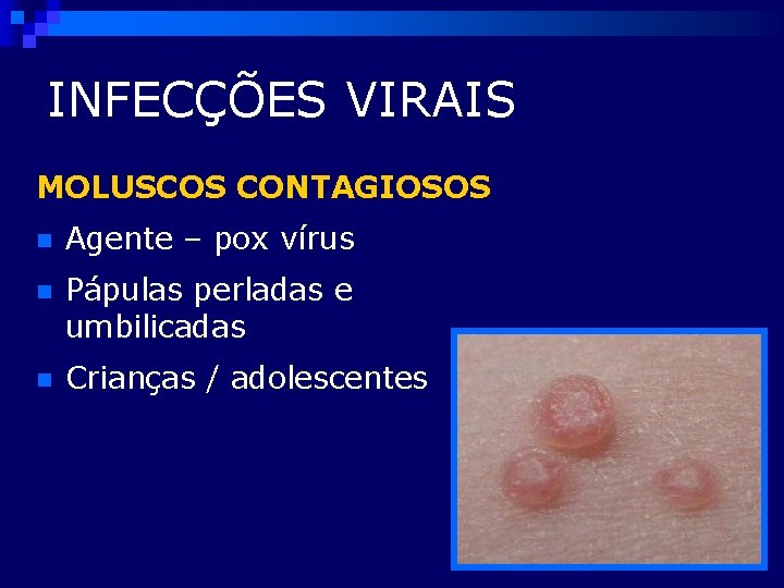 INFECÇÕES VIRAIS MOLUSCOS CONTAGIOSOS n Agente – pox vírus n Pápulas perladas e umbilicadas