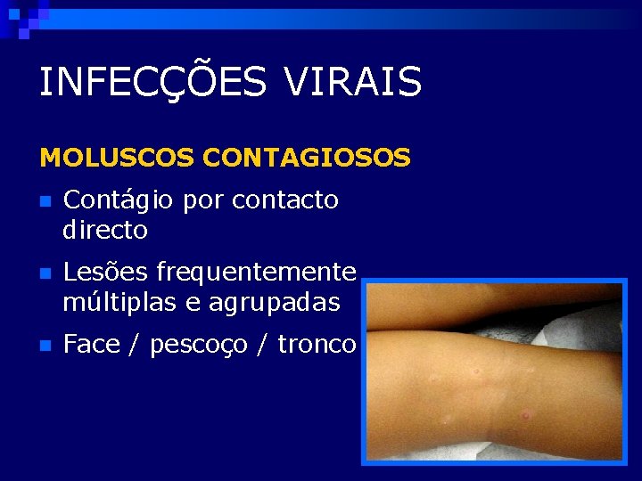 INFECÇÕES VIRAIS MOLUSCOS CONTAGIOSOS n Contágio por contacto directo n Lesões frequentemente múltiplas e