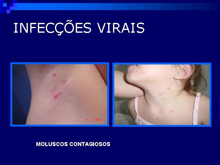 INFECÇÕES VIRAIS MOLUSCOS CONTAGIOSOS 