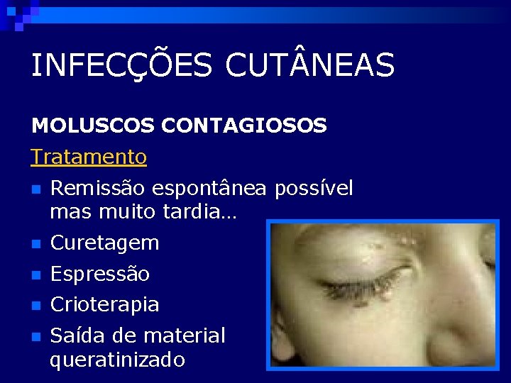 INFECÇÕES CUT NEAS MOLUSCOS CONTAGIOSOS Tratamento n Remissão espontânea possível mas muito tardia… n